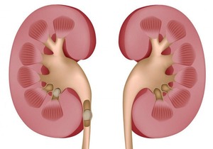 肾结石该如何调理?冬虫夏草可以辅助治疗肾结石吗?